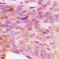 Immunohistochemical analysis of NDUFV3 staining in human breast cancer formalin fixed paraffin embedded tissue section. The section was pre-treated using heat mediated antigen retrieval with sodium citrate buffer (pH 6.0). The section was then incubated with the antibody at room temperature and detected using an HRP conjugad compact polymer system. DAB was used as the chromogen. The section was then counterstained with haematoxylin and mounted with DPX.