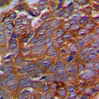 Immunohistochemical analysis of p311 staining in human prostate cancer formalin fixed paraffin embedded tissue section. The section was pre-treated using heat mediated antigen retrieval with sodium citrate buffer (pH 6.0). The section was then incubated with the antibody at room temperature and detected using an HRP conjugad compact polymer system. DAB was used as the chromogen. The section was then counterstained with haematoxylin and mounted with DPX.