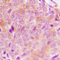 Immunohistochemical analysis of PLC gamma 2 staining in human breast cancer formalin fixed paraffin embedded tissue section. The section was pre-treated using heat mediated antigen retrieval with sodium citrate buffer (pH 6.0). The section was then incubated with the antibody at room temperature and detected using an HRP conjugad compact polymer system. DAB was used as the chromogen. The section was then counterstained with haematoxylin and mounted with DPX.