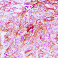 Immunohistochemical analysis of Phospholipase D4 staining in human breast cancer formalin fixed paraffin embedded tissue section. The section was pre-treated using heat mediated antigen retrieval with sodium citrate buffer (pH 6.0). The section was then incubated with the antibody at room temperature and detected using an HRP conjugad compact polymer system. DAB was used as the chromogen. The section was then counterstained with haematoxylin and mounted with DPX.