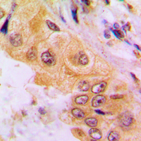 Immunohistochemical analysis of Cytochrome P450 2A7 staining in human liver cancer formalin fixed paraffin embedded tissue section. The section was pre-treated using heat mediated antigen retrieval with sodium citrate buffer (pH 6.0). The section was then incubated with the antibody at room temperature and detected using an HRP conjugated compact polymer system. DAB was used as the chromogen. The section was then counterstained with haematoxylin and mounted with DPX.