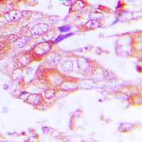 Immunohistochemical analysis of Cytochrome P450 2A13 staining in human lung cancer formalin fixed paraffin embedded tissue section. The section was pre-treated using heat mediated antigen retrieval with sodium citrate buffer (pH 6.0). The section was then incubated with the antibody at room temperature and detected using an HRP conjugated compact polymer system. DAB was used as the chromogen. The section was then counterstained with haematoxylin and mounted with DPX.
