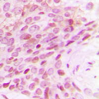 Immunohistochemical analysis of POLR2E staining in human breast cancer formalin fixed paraffin embedded tissue section. The section was pre-treated using heat mediated antigen retrieval with sodium citrate buffer (pH 6.0). The section was then incubated with the antibody at room temperature and detected using an HRP conjugad compact polymer system. DAB was used as the chromogen. The section was then counterstained with haematoxylin and mounted with DPX.