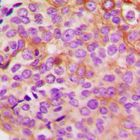 Immunohistochemical analysis of PKA C gamma staining in human breast cancer formalin fixed paraffin embedded tissue section. The section was pre-treated using heat mediated antigen retrieval with sodium citrate buffer (pH 6.0). The section was then incubated with the antibody at room temperature and detected using an HRP conjugad compact polymer system. DAB was used as the chromogen. The section was then counterstained with haematoxylin and mounted with DPX.