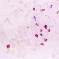 Immunohistochemical analysis of RAD17 staining in human lung cancer formalin fixed paraffin embedded tissue section. The section was pre-treated using heat mediated antigen retrieval with sodium citrate buffer (pH 6.0). The section was then incubated with the antibody at room temperature and detected using an HRP conjugad compact polymer system. DAB was used as the chromogen. The section was then counterstained with haematoxylin and mounted with DPX.