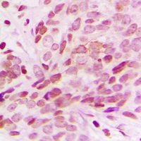 Immunohistochemical analysis of G15 staining in human breast cancer formalin fixed paraffin embedded tissue section. The section was pre-treated using heat mediated antigen retrieval with sodium citrate buffer (pH 6.0). The section was then incubated with the antibody at room temperature and detected using an HRP conjugad compact polymer system. DAB was used as the chromogen. The section was then counterstained with haematoxylin and mounted with DPX.