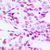 Immunohistochemical analysis of hnRNP G staining in human breast cancer formalin fixed paraffin embedded tissue section. The section was pre-treated using heat mediated antigen retrieval with sodium citrate buffer (pH 6.0). The section was then incubated with the antibody at room temperature and detected using an HRP conjugad compact polymer system. DAB was used as the chromogen. The section was then counterstained with haematoxylin and mounted with DPX.