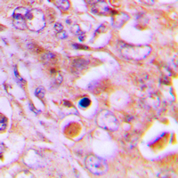 Immunohistochemical analysis of RPL18 staining in human lung cancer formalin fixed paraffin embedded tissue section. The section was pre-treated using heat mediated antigen retrieval with sodium citrate buffer (pH 6.0). The section was then incubated with the antibody at room temperature and detected using an HRP conjugad compact polymer system. DAB was used as the chromogen. The section was then counterstained with haematoxylin and mounted with DPX.