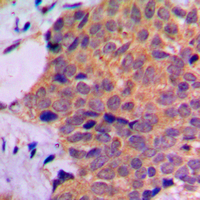 Immunohistochemical analysis of RPL7 staining in human prostate cancer formalin fixed paraffin embedded tissue section. The section was pre-treated using heat mediated antigen retrieval with sodium citrate buffer (pH 6.0). The section was then incubated with the antibody at room temperature and detected using an HRP conjugad compact polymer system. DAB was used as the chromogen. The section was then counterstained with haematoxylin and mounted with DPX.