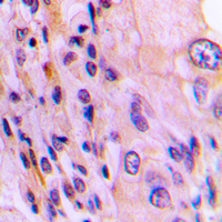 Immunohistochemical analysis of Rhotekin staining in human lung cancer formalin fixed paraffin embedded tissue section. The section was pre-treated using heat mediated antigen retrieval with sodium citrate buffer (pH 6.0). The section was then incubated with the antibody at room temperature and detected using an HRP conjugad compact polymer system. DAB was used as the chromogen. The section was then counterstained with haematoxylin and mounted with DPX.