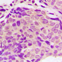 Immunohistochemical analysis of SH2D4A staining in human breast cancer formalin fixed paraffin embedded tissue section. The section was pre-treated using heat mediated antigen retrieval with sodium citrate buffer (pH 6.0). The section was then incubated with the antibody at room temperature and detected using an HRP conjugad compact polymer system. DAB was used as the chromogen. The section was then counterstained with haematoxylin and mounted with DPX.