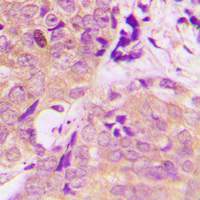Immunohistochemical analysis of CARKL staining in human prostate cancer formalin fixed paraffin embedded tissue section. The section was pre-treated using heat mediated antigen retrieval with sodium citrate buffer (pH 6.0). The section was then incubated with the antibody at room temperature and detected using an HRP conjugad compact polymer system. DAB was used as the chromogen. The section was then counterstained with haematoxylin and mounted with DPX.