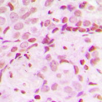 Immunohistochemical analysis of TCOF1 staining in human breast cancer formalin fixed paraffin embedded tissue section. The section was pre-treated using heat mediated antigen retrieval with sodium citrate buffer (pH 6.0). The section was then incubated with the antibody at room temperature and detected using an HRP conjugad compact polymer system. DAB was used as the chromogen. The section was then counterstained with haematoxylin and mounted with DPX.