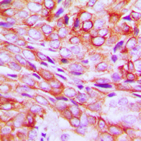Immunohistochemical analysis of TMBIM1 staining in human breast cancer formalin fixed paraffin embedded tissue section. The section was pre-treated using heat mediated antigen retrieval with sodium citrate buffer (pH 6.0). The section was then incubated with the antibody at room temperature and detected using an HRP conjugad compact polymer system. DAB was used as the chromogen. The section was then counterstained with haematoxylin and mounted with DPX.
