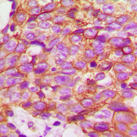 Immunohistochemical analysis of ECHOS1 staining in human breast cancer formalin fixed paraffin embedded tissue section. The section was pre-treated using heat mediated antigen retrieval with sodium citrate buffer (pH 6.0). The section was then incubated with the antibody at room temperature and detected using an HRP conjugad compact polymer system. DAB was used as the chromogen. The section was then counterstained with haematoxylin and mounted with DPX.