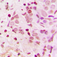 Immunohistochemical analysis of TSHZ1 staining in human breast cancer formalin fixed paraffin embedded tissue section. The section was pre-treated using heat mediated antigen retrieval with sodium citrate buffer (pH 6.0). The section was then incubated with the antibody at room temperature and detected using an HRP conjugad compact polymer system. DAB was used as the chromogen. The section was then counterstained with haematoxylin and mounted with DPX.