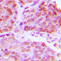 Immunohistochemical analysis of TTF1 staining in human breast cancer formalin fixed paraffin embedded tissue section. The section was pre-treated using heat mediated antigen retrieval with sodium citrate buffer (pH 6.0). The section was then incubated with the antibody at room temperature and detected using an HRP conjugad compact polymer system. DAB was used as the chromogen. The section was then counterstained with haematoxylin and mounted with DPX.