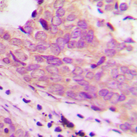 Immunohistochemical analysis of 42064 staining in human prostate cancer formalin fixed paraffin embedded tissue section. The section was pre-treated using heat mediated antigen retrieval with sodium citrate buffer (pH 6.0). The section was then incubated with the antibody at room temperature and detected using an HRP conjugad compact polymer system. DAB was used as the chromogen. The section was then counterstained with haematoxylin and mounted with DPX.