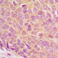 Immunohistochemical analysis of Ataxin 1 (pS775) staining in human breast cancer formalin fixed paraffin embedded tissue section. The section was pre-treated using heat mediated antigen retrieval with sodium citrate buffer (pH 6.0). The section was then incubated with the antibody at room temperature and detected using an HRP conjugad compact polymer system. DAB was used as the chromogen. The section was then counterstained with haematoxylin and mounted with DPX.