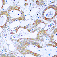 Immunohistochemical analysis of BCR staining in human colon cancer formalin fixed paraffin embedded tissue section. The section was pre-treated using heat mediated antigen retrieval with sodium citrate buffer (pH 6.0). The section was then incubated with the antibody at room temperature and detected using an HRP conjugad compact polymer system. DAB was used as the chromogen. The section was then counterstained with haematoxylin and mounted with DPX.