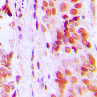 Immunohistochemical analysis of p57 Kip2 staining in human breast cancer formalin fixed paraffin embedded tissue section. The section was pre-treated using heat mediated antigen retrieval with sodium citrate buffer (pH 6.0). The section was then incubated with the antibody at room temperature and detected using an HRP conjugad compact polymer system. DAB was used as the chromogen. The section was then counterstained with haematoxylin and mounted with DPX.