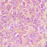 Immunohistochemical analysis of CLASP1 staining in human breast cancer formalin fixed paraffin embedded tissue section. The section was pre-treated using heat mediated antigen retrieval with sodium citrate buffer (pH 6.0). The section was then incubated with the antibody at room temperature and detected using an HRP conjugad compact polymer system. DAB was used as the chromogen. The section was then counterstained with haematoxylin and mounted with DPX.