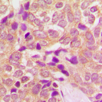 Immunohistochemical analysis of CPT1B staining in human breast cancer formalin fixed paraffin embedded tissue section. The section was pre-treated using heat mediated antigen retrieval with sodium citrate buffer (pH 6.0). The section was then incubated with the antibody at room temperature and detected using an HRP conjugad compact polymer system. DAB was used as the chromogen. The section was then counterstained with haematoxylin and mounted with DPX.