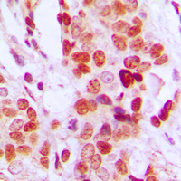 Immunohistochemical analysis of DDX52 staining in human breast cancer formalin fixed paraffin embedded tissue section. The section was pre-treated using heat mediated antigen retrieval with sodium citrate buffer (pH 6.0). The section was then incubated with the antibody at room temperature and detected using an HRP conjugad compact polymer system. DAB was used as the chromogen. The section was then counterstained with haematoxylin and mounted with DPX.
