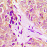 Immunohistochemical analysis of DDX55 staining in human breast cancer formalin fixed paraffin embedded tissue section. The section was pre-treated using heat mediated antigen retrieval with sodium citrate buffer (pH 6.0). The section was then incubated with the antibody at room temperature and detected using an HRP conjugad compact polymer system. DAB was used as the chromogen. The section was then counterstained with haematoxylin and mounted with DPX.