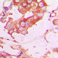 Immunohistochemical analysis of EPN2 staining in human lung cancer formalin fixed paraffin embedded tissue section. The section was pre-treated using heat mediated antigen retrieval with sodium citrate buffer (pH 6.0). The section was then incubated with the antibody at room temperature and detected using an HRP conjugad compact polymer system. DAB was used as the chromogen. The section was then counterstained with haematoxylin and mounted with DPX.