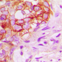 Immunohistochemical analysis of KSR1 staining in human breast cancer formalin fixed paraffin embedded tissue section. The section was pre-treated using heat mediated antigen retrieval with sodium citrate buffer (pH 6.0). The section was then incubated with the antibody at room temperature and detected using an HRP conjugad compact polymer system. DAB was used as the chromogen. The section was then counterstained with haematoxylin and mounted with DPX.
