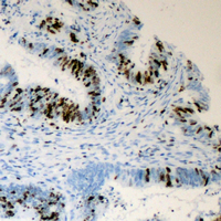 Immunohistochemical analysis of TRAP220 (pT1457) staining in human colon cancer formalin fixed paraffin embedded tissue section. The section was pre-treated using heat mediated antigen retrieval with sodium citrate buffer (pH 6.0). The section was then incubated with the antibody at room temperature and detected using an HRP conjugad compact polymer system. DAB was used as the chromogen. The section was then counterstained with haematoxylin and mounted with DPX.