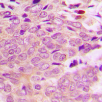 Immunohistochemical analysis of MRPL40 staining in human breast cancer formalin fixed paraffin embedded tissue section. The section was pre-treated using heat mediated antigen retrieval with sodium citrate buffer (pH 6.0). The section was then incubated with the antibody at room temperature and detected using an HRP conjugad compact polymer system. DAB was used as the chromogen. The section was then counterstained with haematoxylin and mounted with DPX.