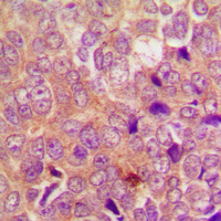 Immunohistochemical analysis of UBR1 staining in human breast cancer formalin fixed paraffin embedded tissue section. The section was pre-treated using heat mediated antigen retrieval with sodium citrate buffer (pH 6.0). The section was then incubated with the antibody at room temperature and detected using an HRP conjugad compact polymer system. DAB was used as the chromogen. The section was then counterstained with haematoxylin and mounted with DPX.