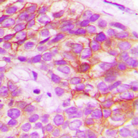 Immunohistochemical analysis of ELOVL5 staining in human breast cancer formalin fixed paraffin embedded tissue section. The section was pre-treated using heat mediated antigen retrieval with sodium citrate buffer (pH 6.0). The section was then incubated with the antibody at room temperature and detected using an HRP conjugated compact polymer system. DAB was used as the chromogen. The section was then counterstained with haematoxylin and mounted with DPX.