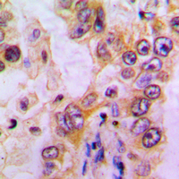 Immunohistochemical analysis of EHHADH staining in human liver cancer formalin fixed paraffin embedded tissue section. The section was pre-treated using heat mediated antigen retrieval with sodium citrate buffer (pH 6.0). The section was then incubated with the antibody at room temperature and detected using an HRP conjugated compact polymer system. DAB was used as the chromogen. The section was then counterstained with haematoxylin and mounted with DPX.