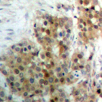Immunohistochemical analysis of ERK7 (pT175/Y177) staining in human breast cancer formalin fixed paraffin embedded tissue section. The section was pre-treated using heat mediated antigen retrieval with sodium citrate buffer (pH 6.0). The section was then incubated with the antibody at room temperature and detected using an HRP conjugated compact polymer system. DAB was used as the chromogen. The section was then counterstained with haematoxylin and mounted with DPX.