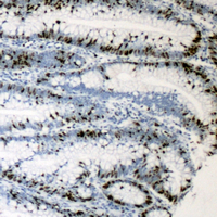 Immunohistochemical analysis of MKI67IP staining in human colon cancer formalin fixed paraffin embedded tissue section. The section was pre-treated using heat mediated antigen retrieval with sodium citrate buffer (pH 6.0). The section was then incubated with the antibody at room temperature and detected using an HRP conjugated compact polymer system. DAB was used as the chromogen. The section was then counterstained with haematoxylin and mounted with DPX.