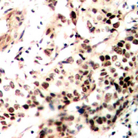 Immunohistochemical analysis of SMRT staining in human breast cancer formalin fixed paraffin embedded tissue section. The section was pre-treated using heat mediated antigen retrieval with sodium citrate buffer (pH 6.0). The section was then incubated with the antibody at room temperature and detected using an HRP conjugated compact polymer system. DAB was used as the chromogen. The section was then counterstained with haematoxylin and mounted with DPX.