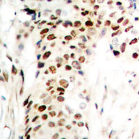 Immunohistochemical analysis of Zep-1 staining in human breast cancer formalin fixed paraffin embedded tissue section. The section was pre-treated using heat mediated antigen retrieval with sodium citrate buffer (pH 6.0). The section was then incubated with the antibody at room temperature and detected using an HRP conjugated compact polymer system. DAB was used as the chromogen. The section was then counterstained with haematoxylin and mounted with DPX.