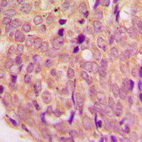 Immunohistochemical analysis of WASF1 staining in human breast cancer formalin fixed paraffin embedded tissue section. The section was pre-treated using heat mediated antigen retrieval with sodium citrate buffer (pH 6.0). The section was then incubated with the antibody at room temperature and detected using an HRP conjugated compact polymer system. DAB was used as the chromogen. The section was then counterstained with haematoxylin and mounted with DPX.