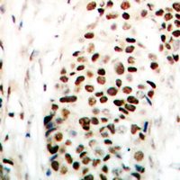 Immunohistochemical analysis of NIPA (pS354) staining in human breast cancer formalin fixed paraffin embedded tissue section. The section was pre-treated using heat mediated antigen retrieval with sodium citrate buffer (pH 6.0). The section was then incubated with the antibody at room temperature and detected using an HRP conjugated compact polymer system. DAB was used as the chromogen. The section was then counterstained with haematoxylin and mounted with DPX.