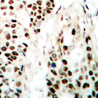 Immunohistochemical analysis of NIPA staining in human breast cancer formalin fixed paraffin embedded tissue section. The section was pre-treated using heat mediated antigen retrieval with sodium citrate buffer (pH 6.0). The section was then incubated with the antibody at room temperature and detected using an HRP conjugated compact polymer system. DAB was used as the chromogen. The section was then counterstained with haematoxylin and mounted with DPX.