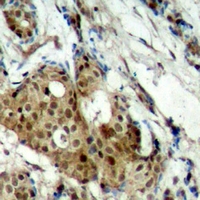 Immunohistochemical analysis of CDK11B staining in human breast cancer formalin fixed paraffin embedded tissue section. The section was pre-treated using heat mediated antigen retrieval with sodium citrate buffer (pH 6.0). The section was then incubated with the antibody at room temperature and detected using an HRP conjugacompact polymer system. DAB was used as the chromogen. The section was then counterstained with haematoxylin and mounted with DPX.
