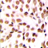 Immunohistochemical analysis of NFYB staining in human breast cancer formalin fixed paraffin embedded tissue section. The section was pre-treated using heat mediated antigen retrieval with sodium citrate buffer (pH 6.0). The section was then incubated with the antibody at room temperature and detected using an HRP conjugacompact polymer system. DAB was used as the chromogen. The section was then counterstained with haematoxylin and mounted with DPX.