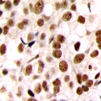 Immunohistochemical analysis of C/EBP zeta staining in human breast cancer formalin fixed paraffin embedded tissue section. The section was pre-treated using heat mediated antigen retrieval with sodium citrate buffer (pH 6.0). The section was then incubated with the antibody at room temperature and detected using an HRP conjugacompact polymer system. DAB was used as the chromogen. The section was then counterstained with haematoxylin and mounted with DPX.