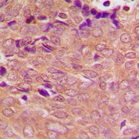 Immunohistochemical analysis of PSMC3 staining in human breast cancer formalin fixed paraffin embedded tissue section. The section was pre-treated using heat mediated antigen retrieval with sodium citrate buffer (pH 6.0). The section was then incubated with the antibody at room temperature and detected using an HRP conjugacompact polymer system. DAB was used as the chromogen. The section was then counterstained with haematoxylin and mounted with DPX.