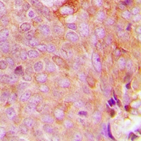 Immunohistochemical analysis of MRPS9 staining in human breast cancer formalin fixed paraffin embedded tissue section. The section was pre-treated using heat mediated antigen retrieval with sodium citrate buffer (pH 6.0). The section was then incubated with the antibody at room temperature and detected using an HRP conjugacompact polymer system. DAB was used as the chromogen. The section was then counterstained with haematoxylin and mounted with DPX.