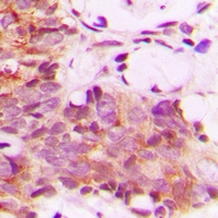 Immunohistochemical analysis of CNTROB staining in human breast cancer formalin fixed paraffin embedded tissue section. The section was pre-treated using heat mediated antigen retrieval with sodium citrate buffer (pH 6.0). The section was then incubated with the antibody at room temperature and detected using an HRP conjugacompact polymer system. DAB was used as the chromogen. The section was then counterstained with haematoxylin and mounted with DPX.