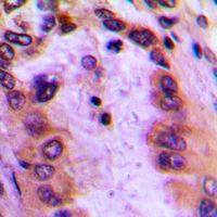 Immunohistochemical analysis of GBP4 staining in human lung cancer formalin fixed paraffin embedded tissue section. The section was pre-treated using heat mediated antigen retrieval with sodium citrate buffer (pH 6.0). The section was then incubated with the antibody at room temperature and detected using an HRP conjugacompact polymer system. DAB was used as the chromogen. The section was then counterstained with haematoxylin and mounted with DPX.